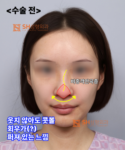 콧볼축소를 원하셨지만, 하면 안 됐던 코! 코끝이 먼저였던 이유 sh성형외과 에스에이치성형외과 사진 22