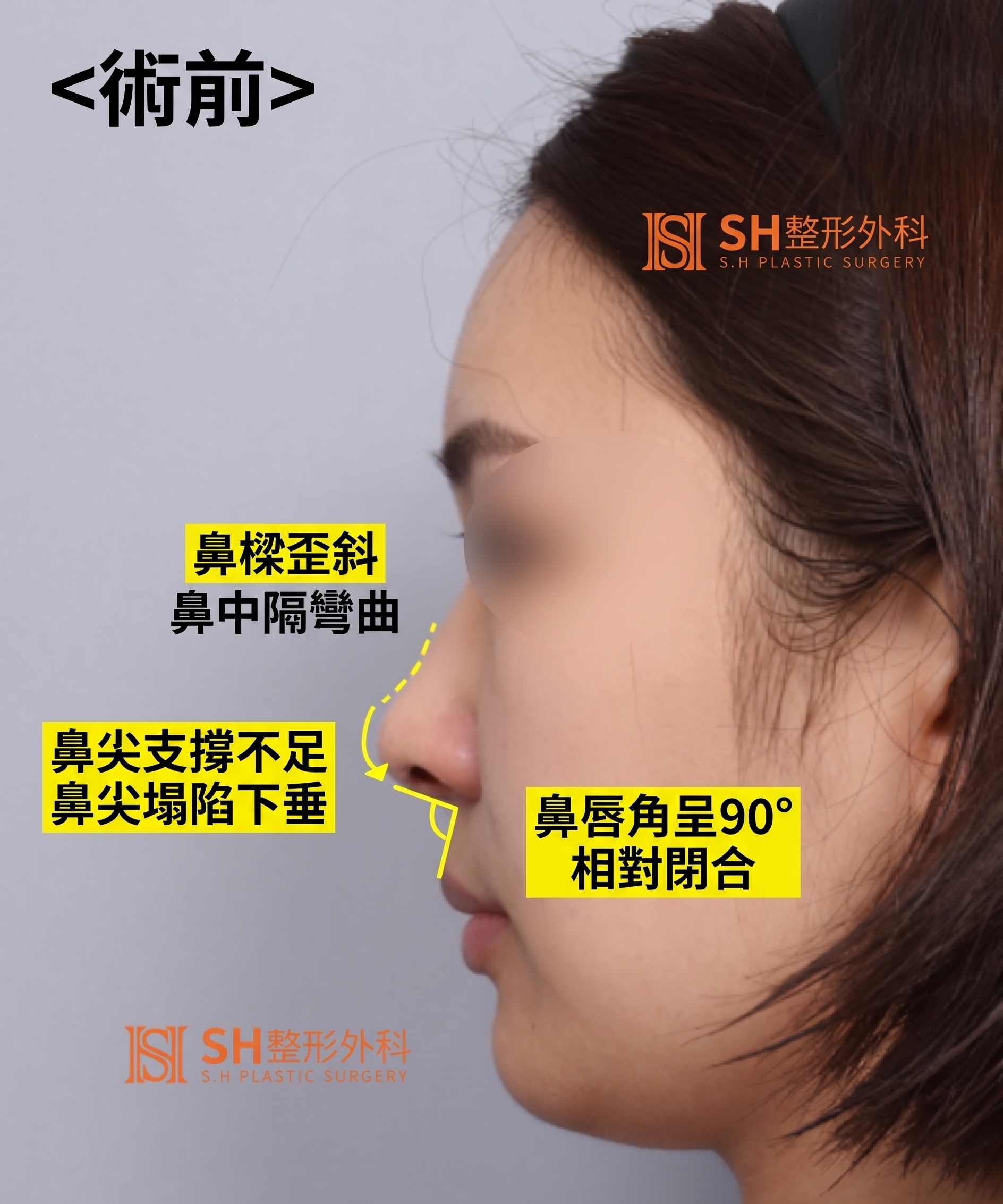想縮鼻翼卻不適合?鼻尖才是關鍵的原因!SH整形外科 사진 18