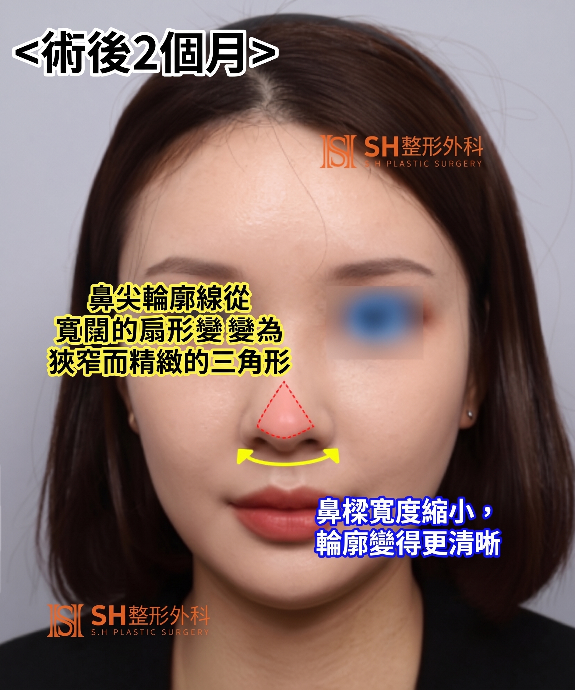 想縮鼻翼卻不適合?鼻尖才是關鍵的原因!SH整形外科 사진 17