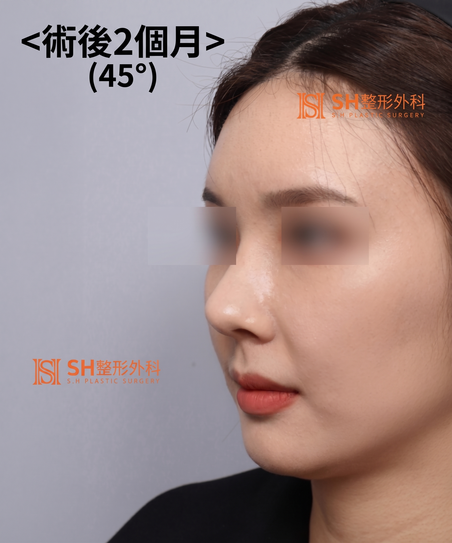 想縮鼻翼卻不適合?鼻尖才是關鍵的原因!SH整形外科 사진 35