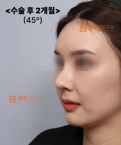 콧볼축소를 원하셨지만, 하면 안 됐던 코! 코끝이 먼저였던 이유 sh성형외과 에스에이치성형외과 사진 35