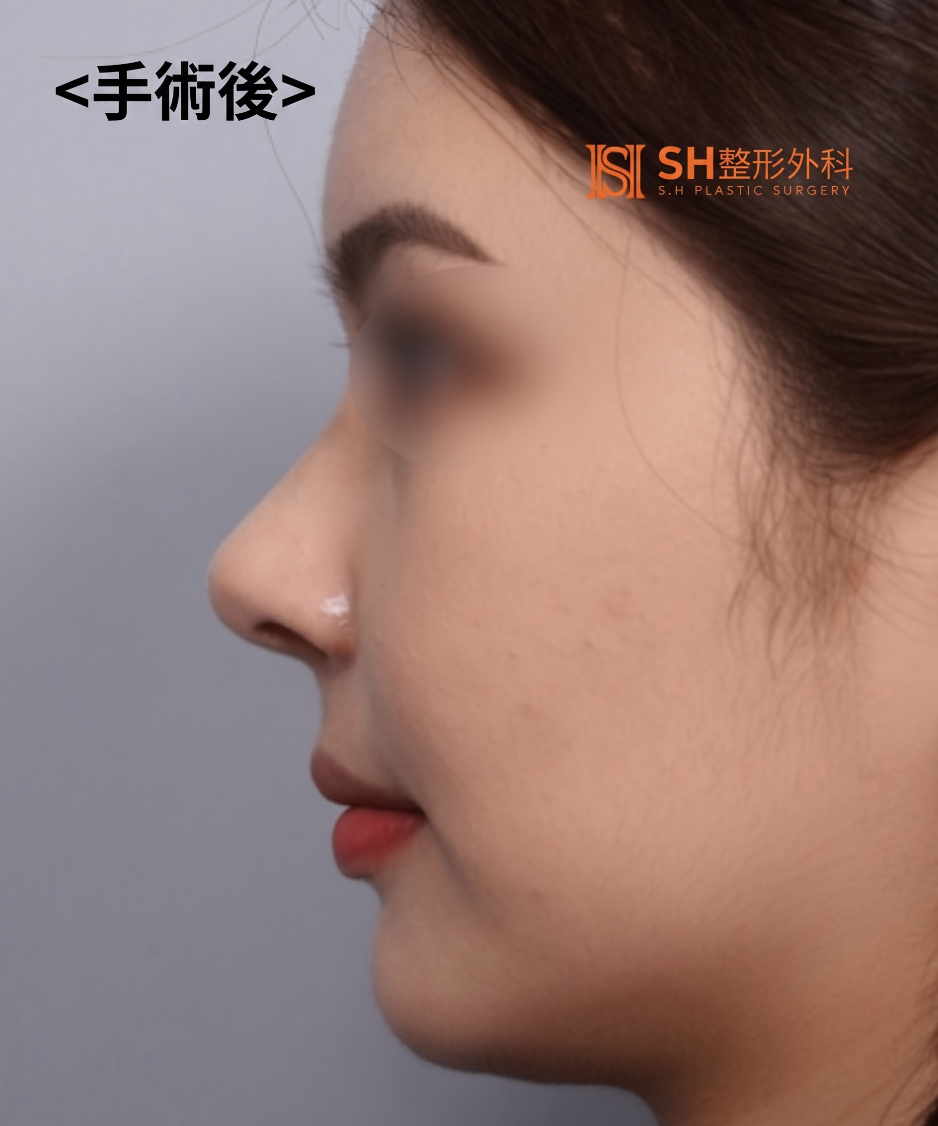 想縮鼻翼卻不適合?鼻尖才是關鍵的原因!SH整形外科 사진 4