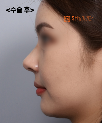 콧볼축소를 원하셨지만, 하면 안 됐던 코! 코끝이 먼저였던 이유 sh성형외과 에스에이치성형외과 사진 4