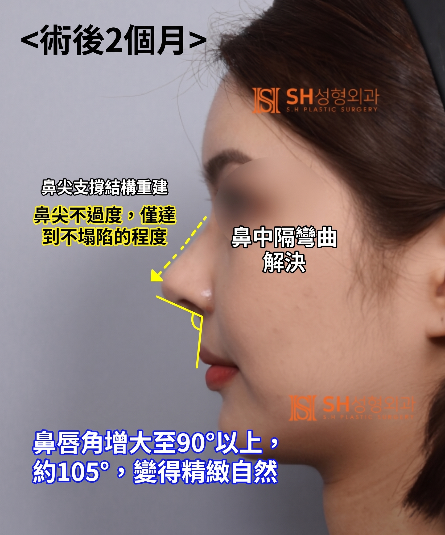 想縮鼻翼卻不適合?鼻尖才是關鍵的原因!SH整形外科 사진 26