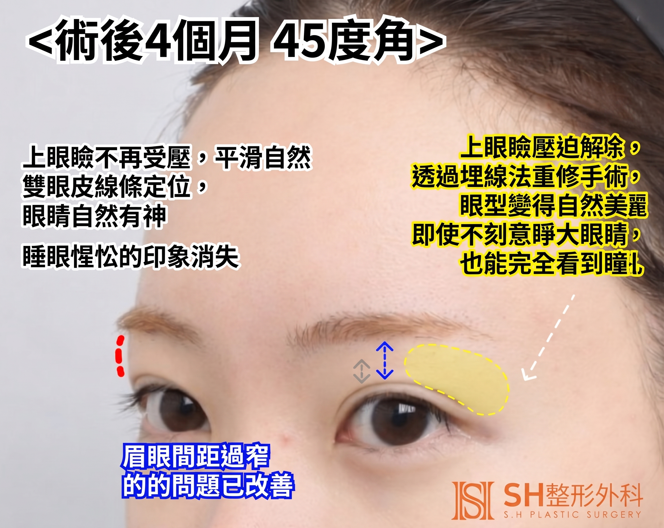 內視鏡前額拉提術、縫線式雙眼皮重修術與眉下切開拉提術,恢復眼部結構 SH整形外科 사진 9