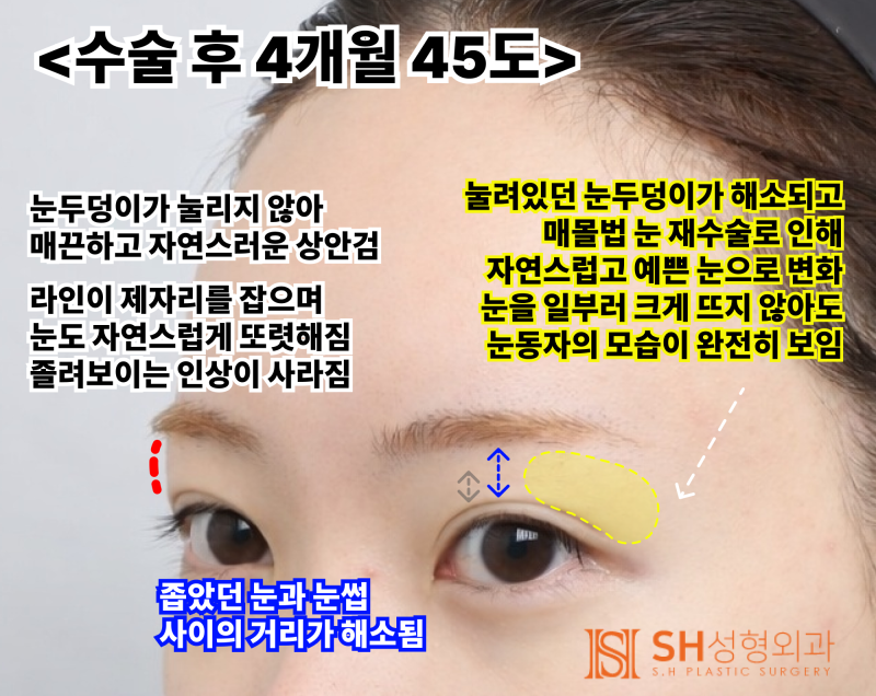 내시경 이마거상술과 매몰 쌍꺼풀 재수술, 눈썹하거상술로 회복된 눈매 구조 SH성형외과 에스에이치성형외과 사진 9