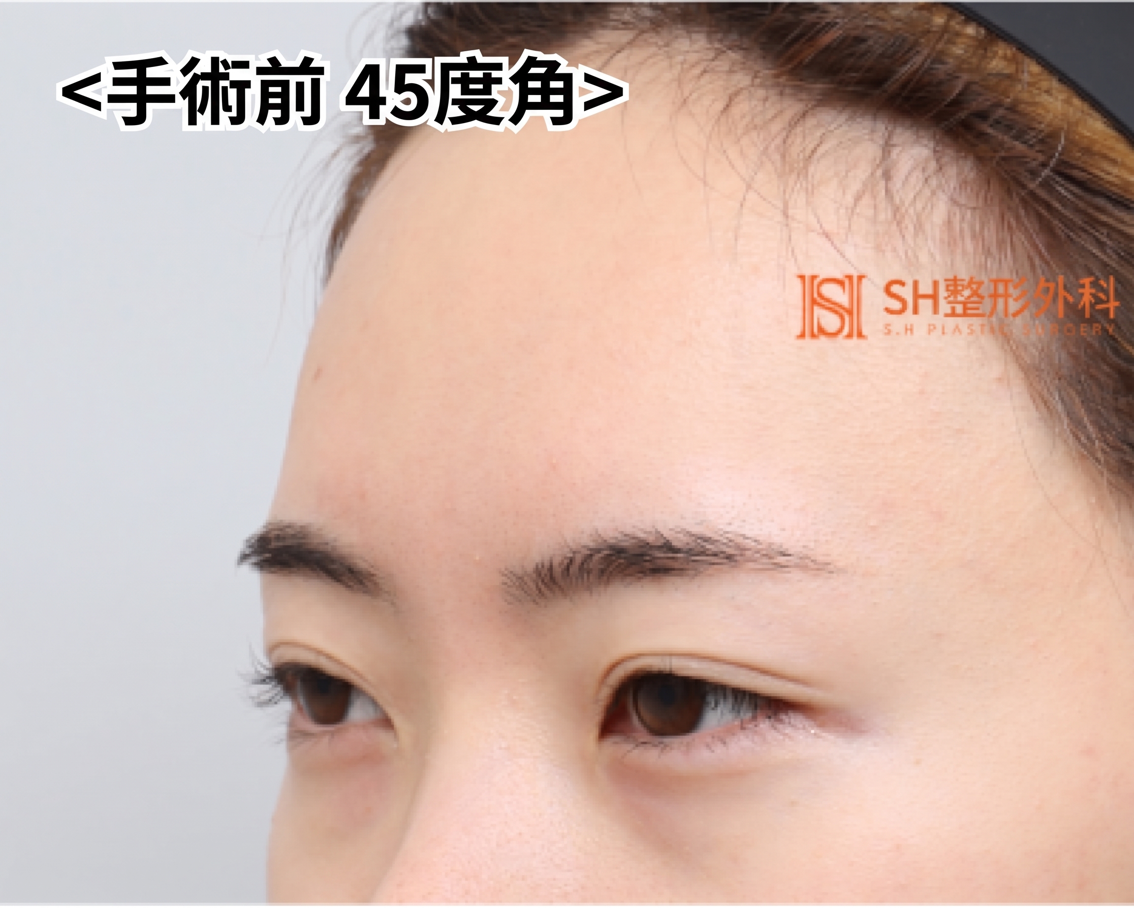 內視鏡前額拉提術、縫線式雙眼皮重修術與眉下切開拉提術,恢復眼部結構 SH整形外科 사진 3