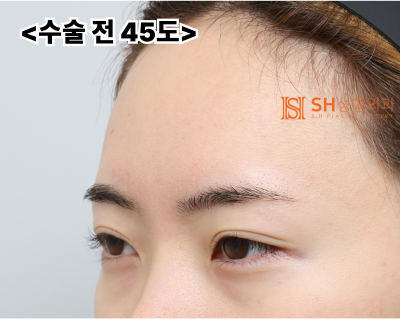 내시경 이마거상술과 매몰 쌍꺼풀 재수술, 눈썹하거상술로 회복된 눈매 구조 SH성형외과 에스에이치성형외과 사진 3