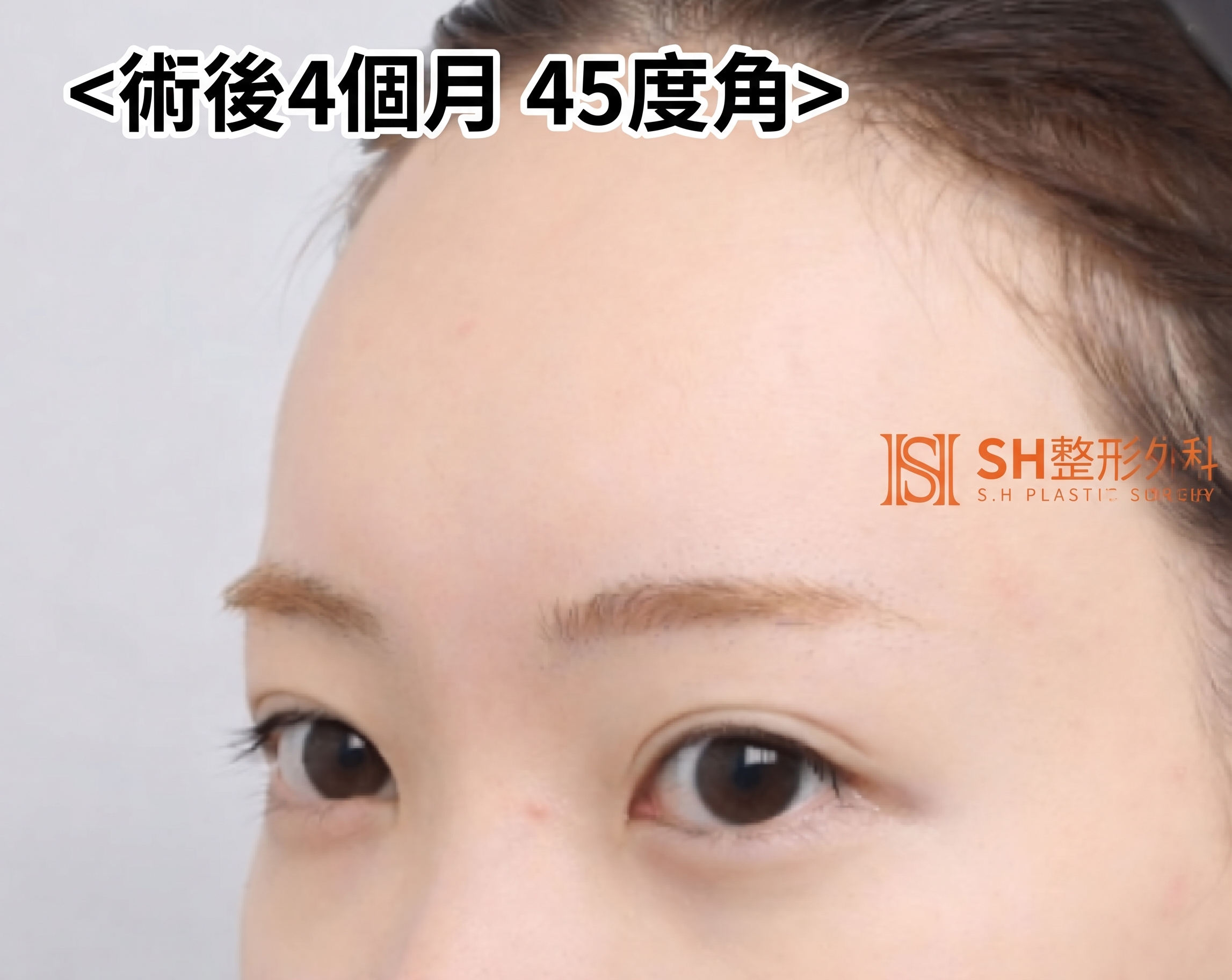 內視鏡前額拉提術、縫線式雙眼皮重修術與眉下切開拉提術,恢復眼部結構 SH整形外科 사진 4