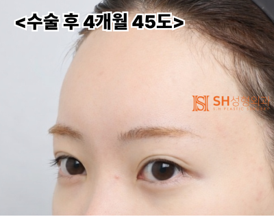 내시경 이마거상술과 매몰 쌍꺼풀 재수술, 눈썹하거상술로 회복된 눈매 구조 SH성형외과 에스에이치성형외과 사진 4