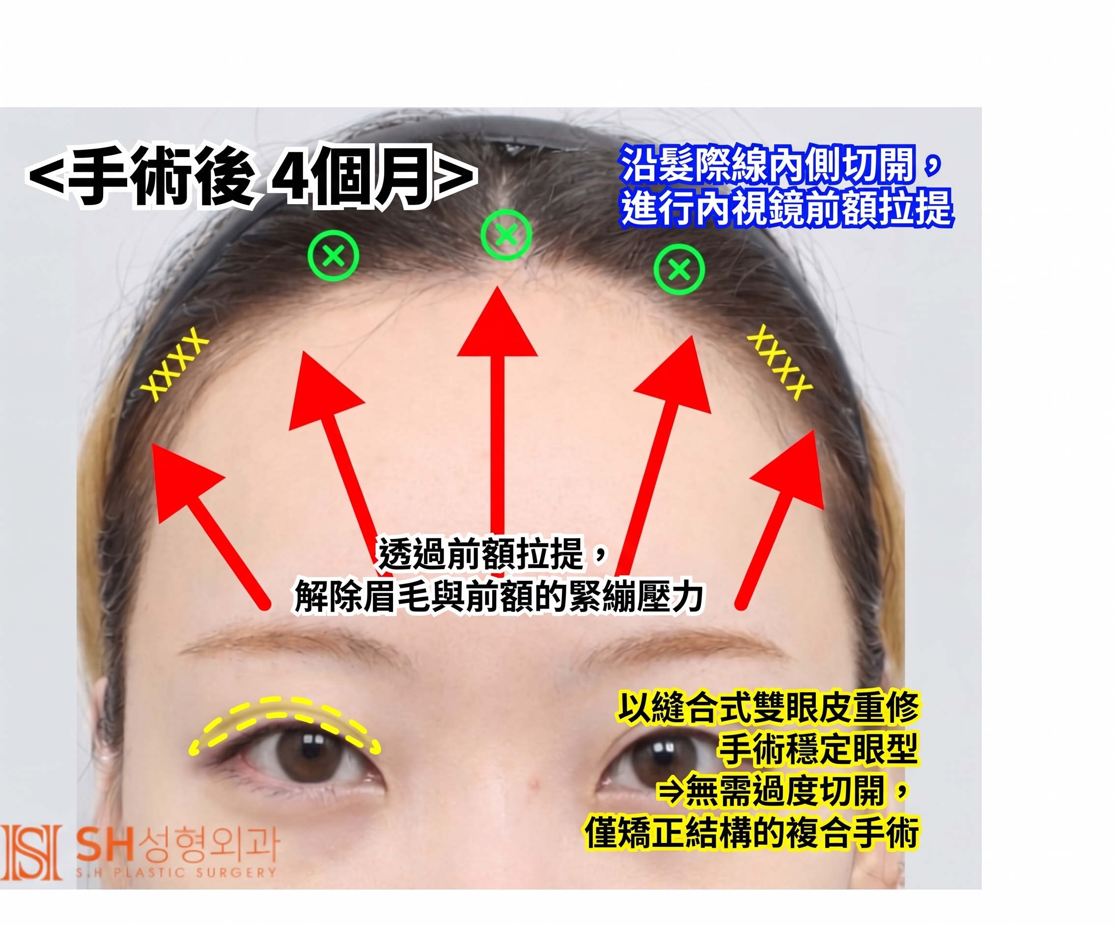 內視鏡前額拉提術、縫線式雙眼皮重修術與眉下切開拉提術,恢復眼部結構 SH整形外科 사진 8