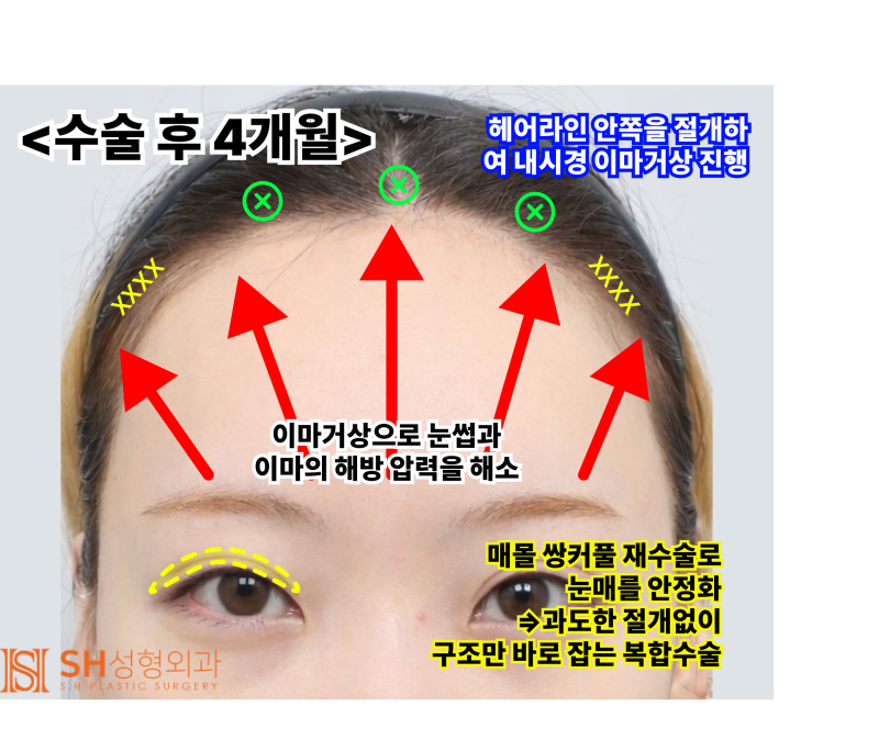 내시경 이마거상술과 매몰 쌍꺼풀 재수술, 눈썹하거상술로 회복된 눈매 구조 SH성형외과 에스에이치성형외과 사진 8