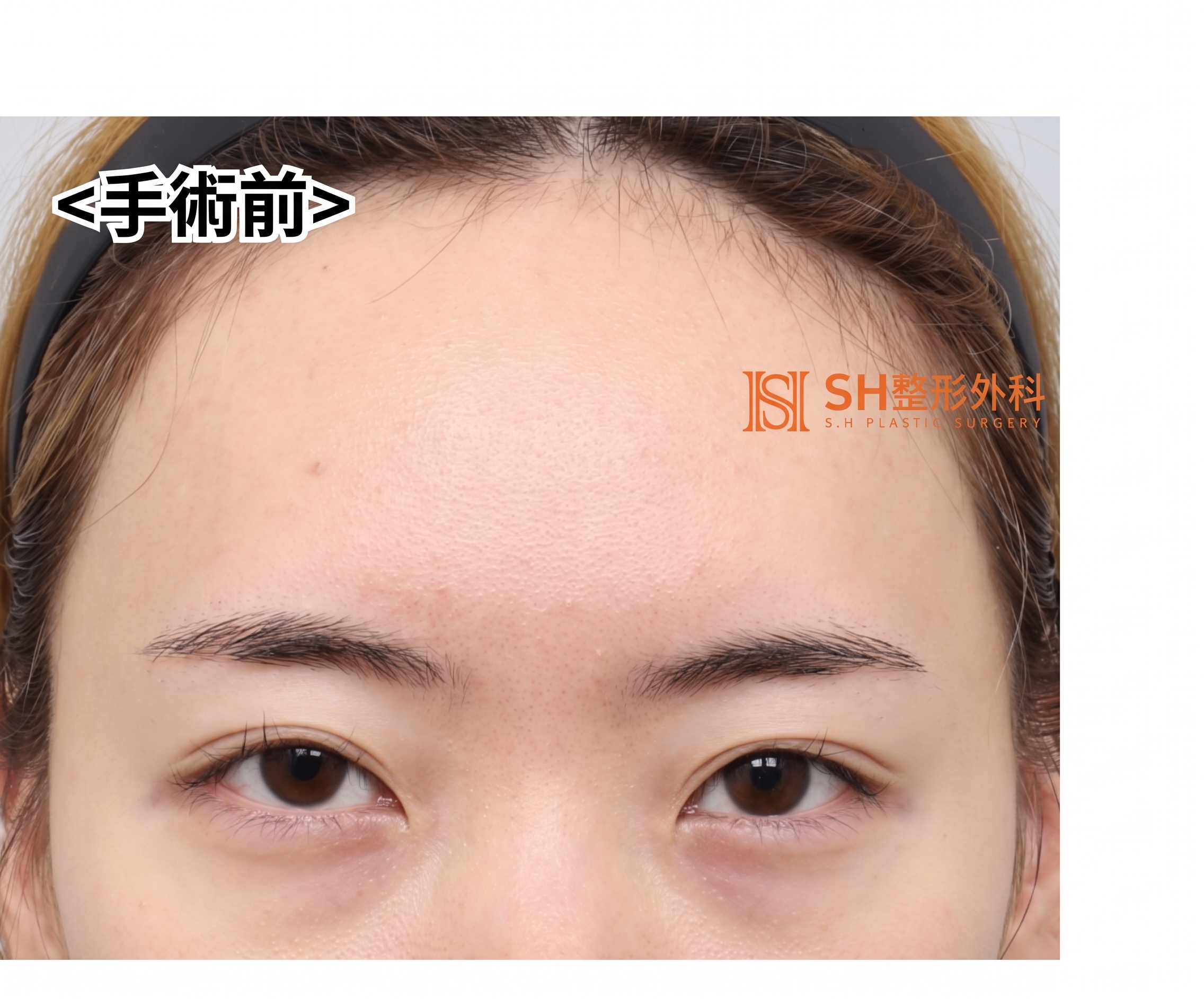 內視鏡前額拉提術、縫線式雙眼皮重修術與眉下切開拉提術,恢復眼部結構 SH整形外科 사진 5