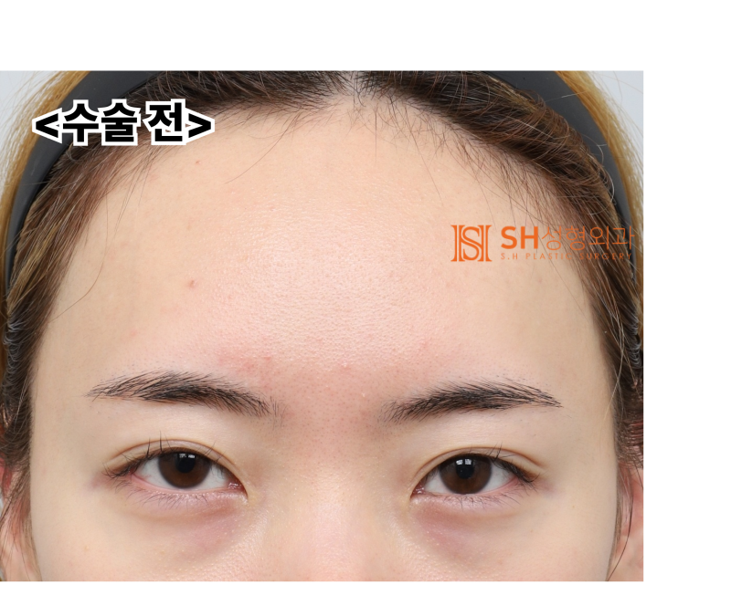 내시경 이마거상술과 매몰 쌍꺼풀 재수술, 눈썹하거상술로 회복된 눈매 구조 SH성형외과 에스에이치성형외과 사진 5