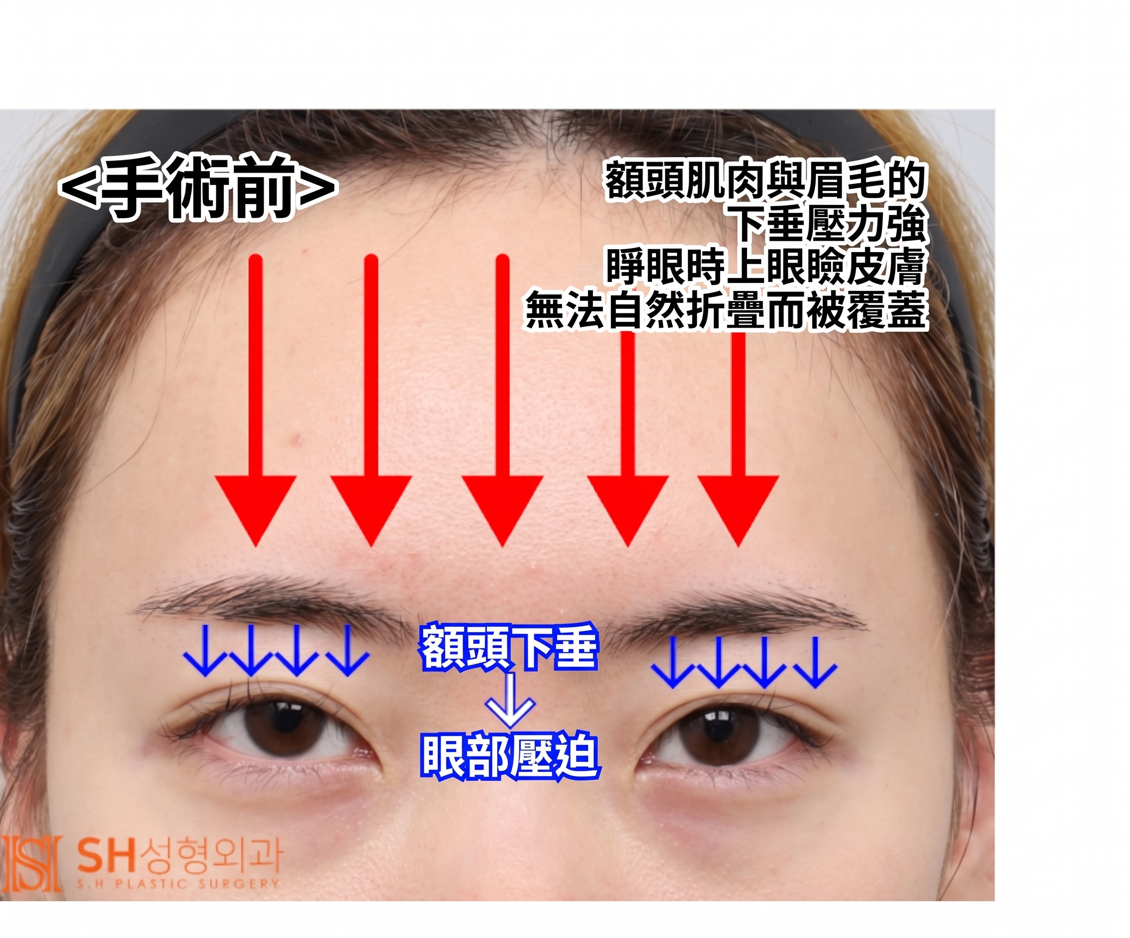 內視鏡前額拉提術、縫線式雙眼皮重修術與眉下切開拉提術,恢復眼部結構 SH整形外科 사진 7