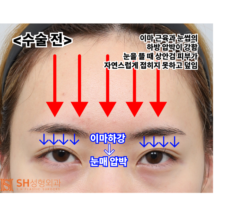 내시경 이마거상술과 매몰 쌍꺼풀 재수술, 눈썹하거상술로 회복된 눈매 구조 SH성형외과 에스에이치성형외과 사진 7
