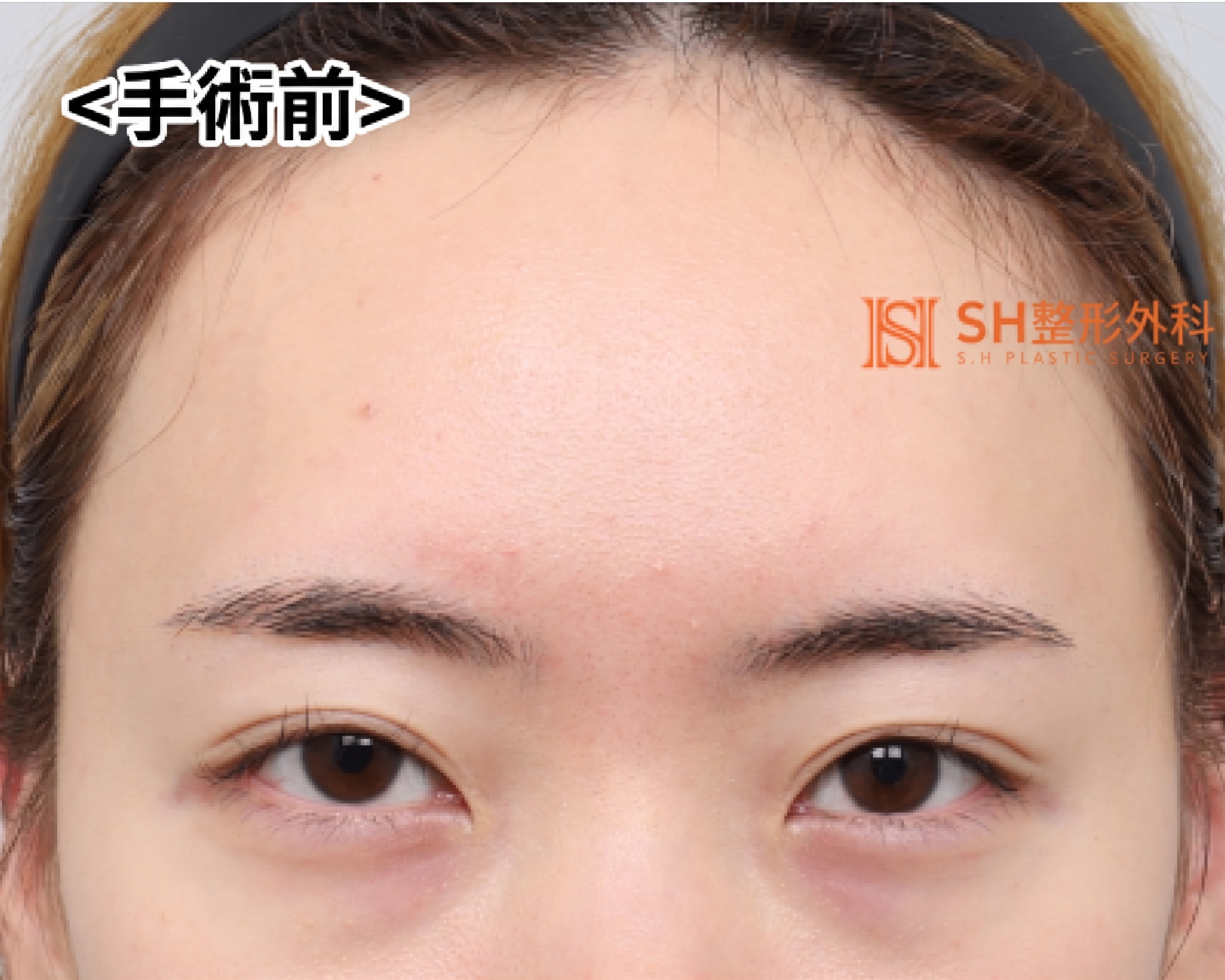 內視鏡前額拉提術、縫線式雙眼皮重修術與眉下切開拉提術,恢復眼部結構 SH整形外科