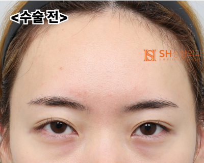 내시경 이마거상술과 매몰 쌍꺼풀 재수술, 눈썹하거상술로 회복된 눈매 구조 SH성형외과 에스에이치성형외과