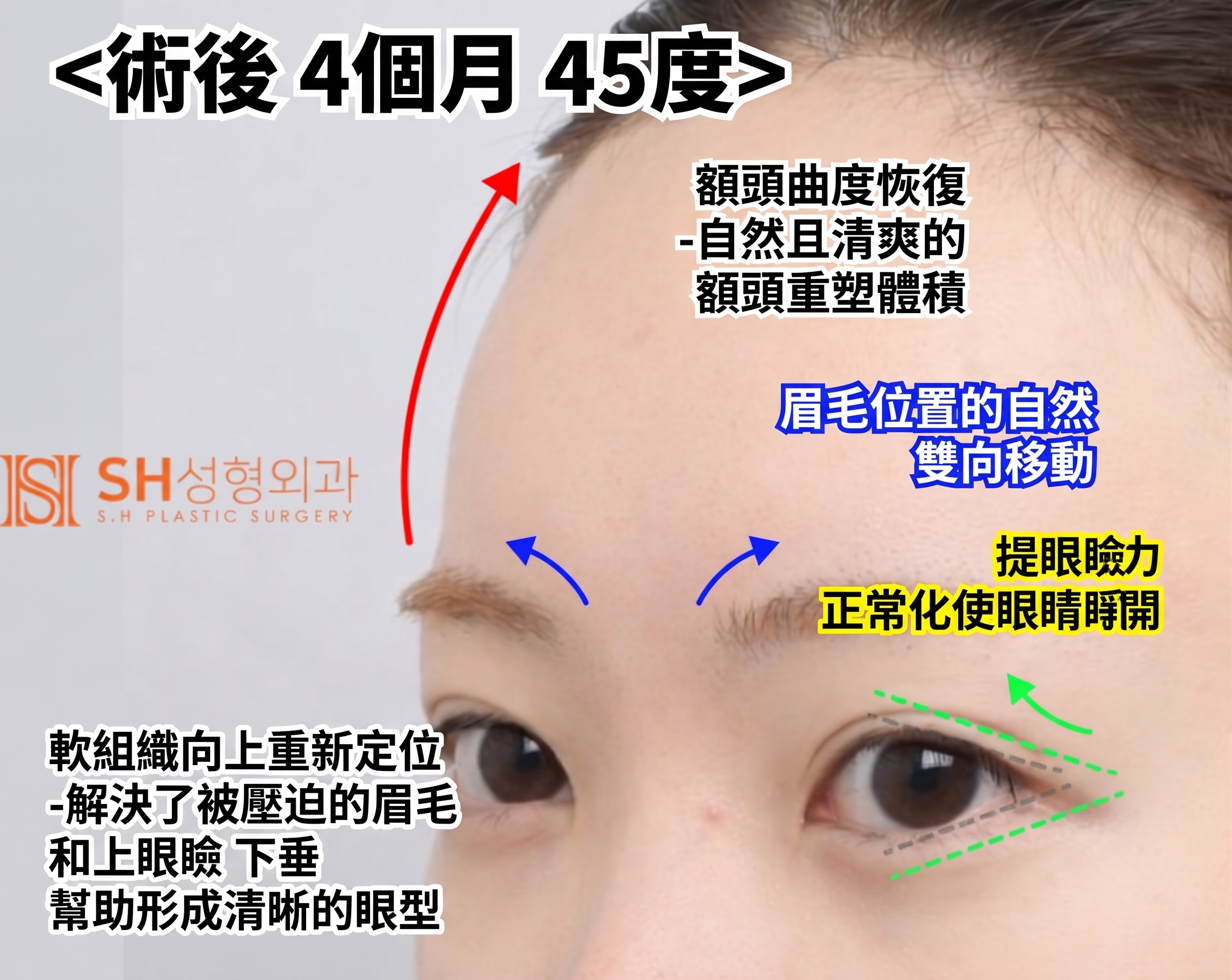 內視鏡前額拉提術、縫線式雙眼皮重修術與眉下切開拉提術,恢復眼部結構 SH整形外科 사진 12