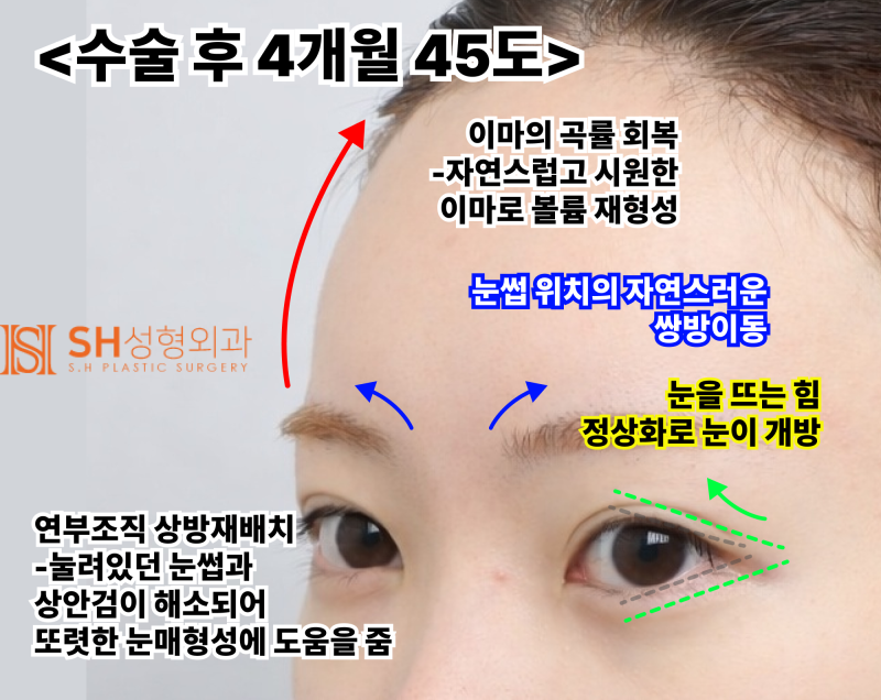 내시경 이마거상술과 매몰 쌍꺼풀 재수술, 눈썹하거상술로 회복된 눈매 구조 SH성형외과 에스에이치성형외과 사진 12