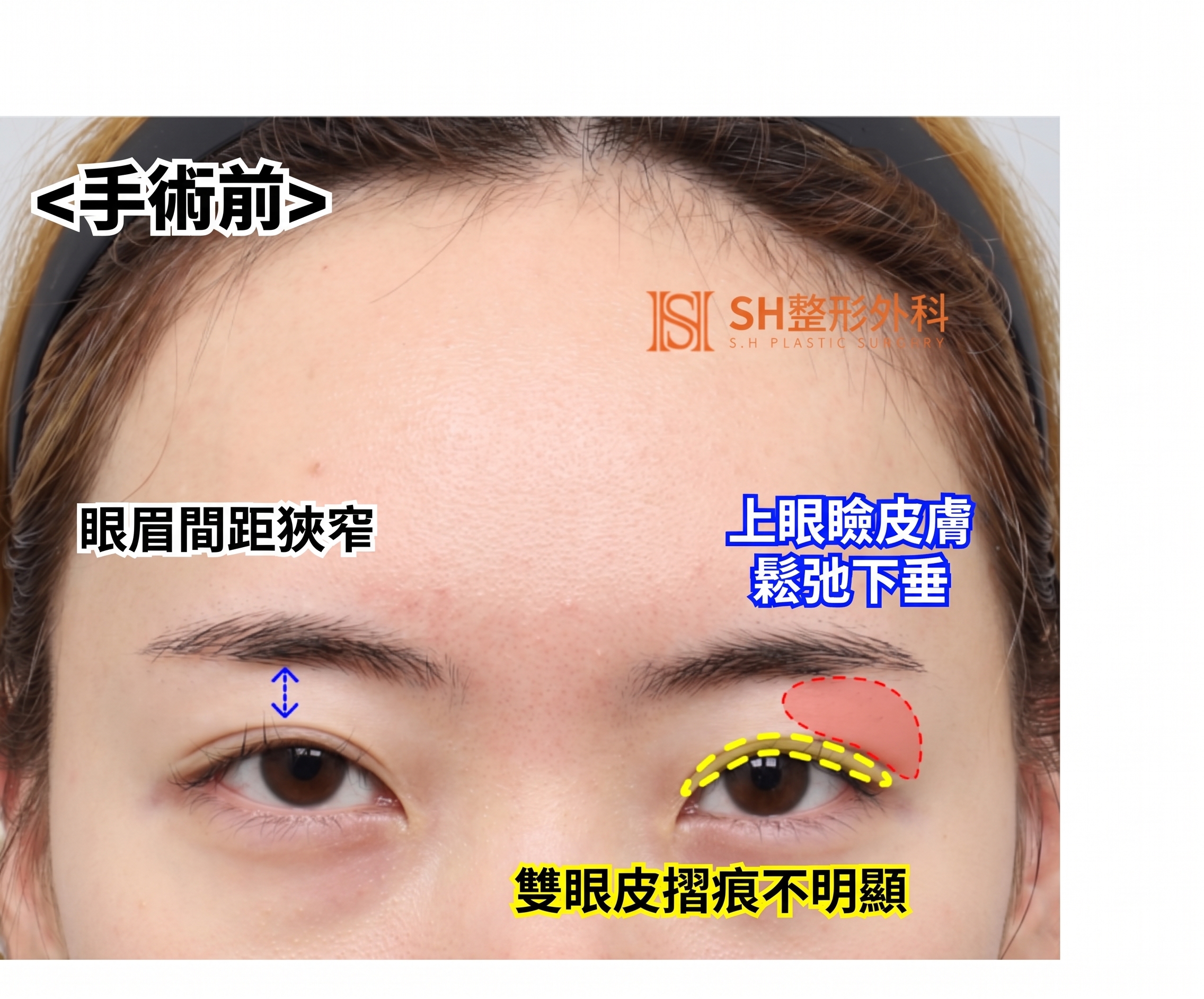 內視鏡前額拉提術、縫線式雙眼皮重修術與眉下切開拉提術,恢復眼部結構 SH整形外科 사진 6