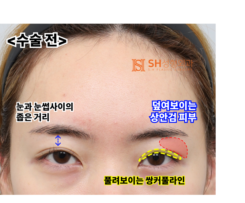 내시경 이마거상술과 매몰 쌍꺼풀 재수술, 눈썹하거상술로 회복된 눈매 구조 SH성형외과 에스에이치성형외과 사진 6