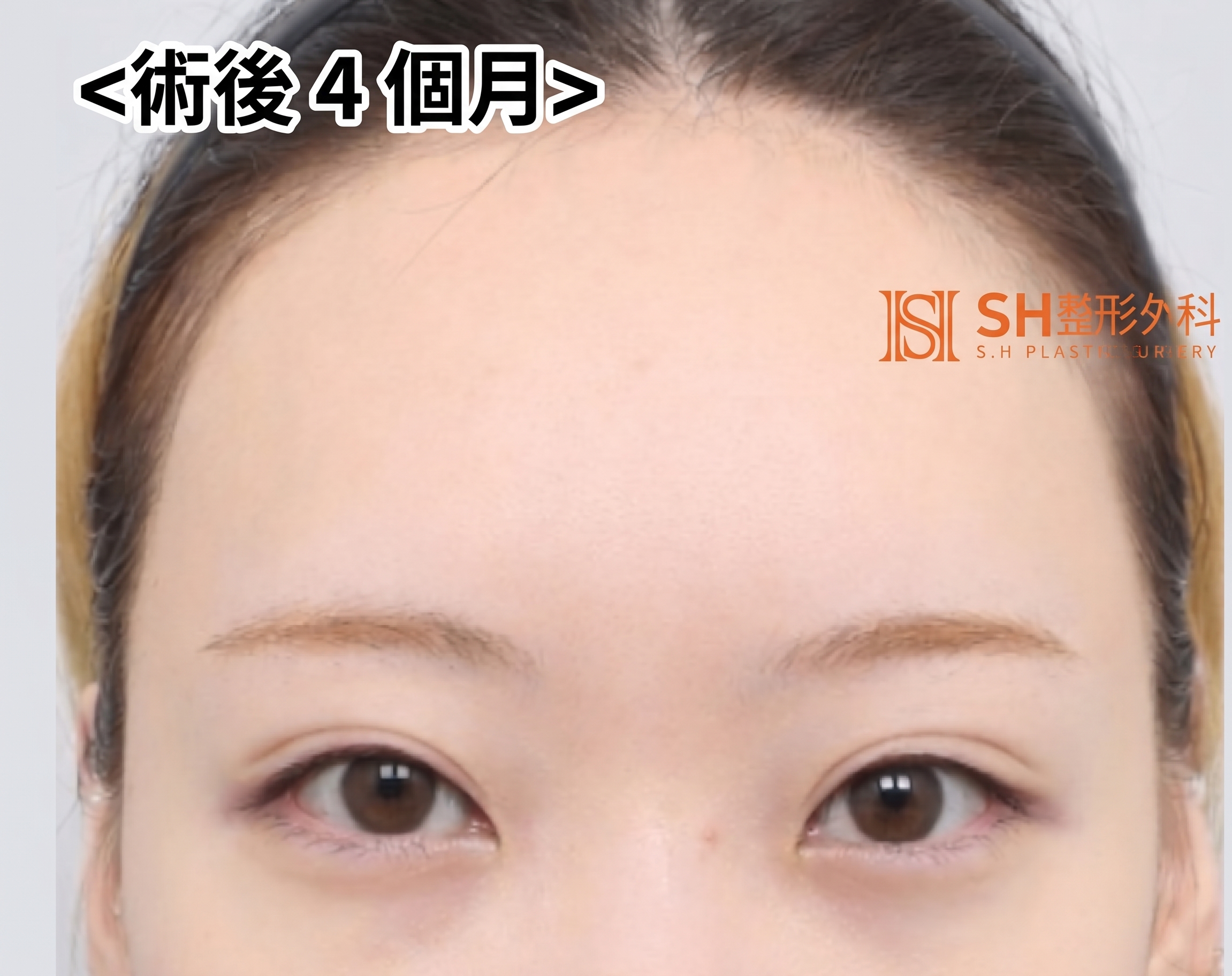 內視鏡前額拉提術、縫線式雙眼皮重修術與眉下切開拉提術,恢復眼部結構 SH整形外科 사진 2