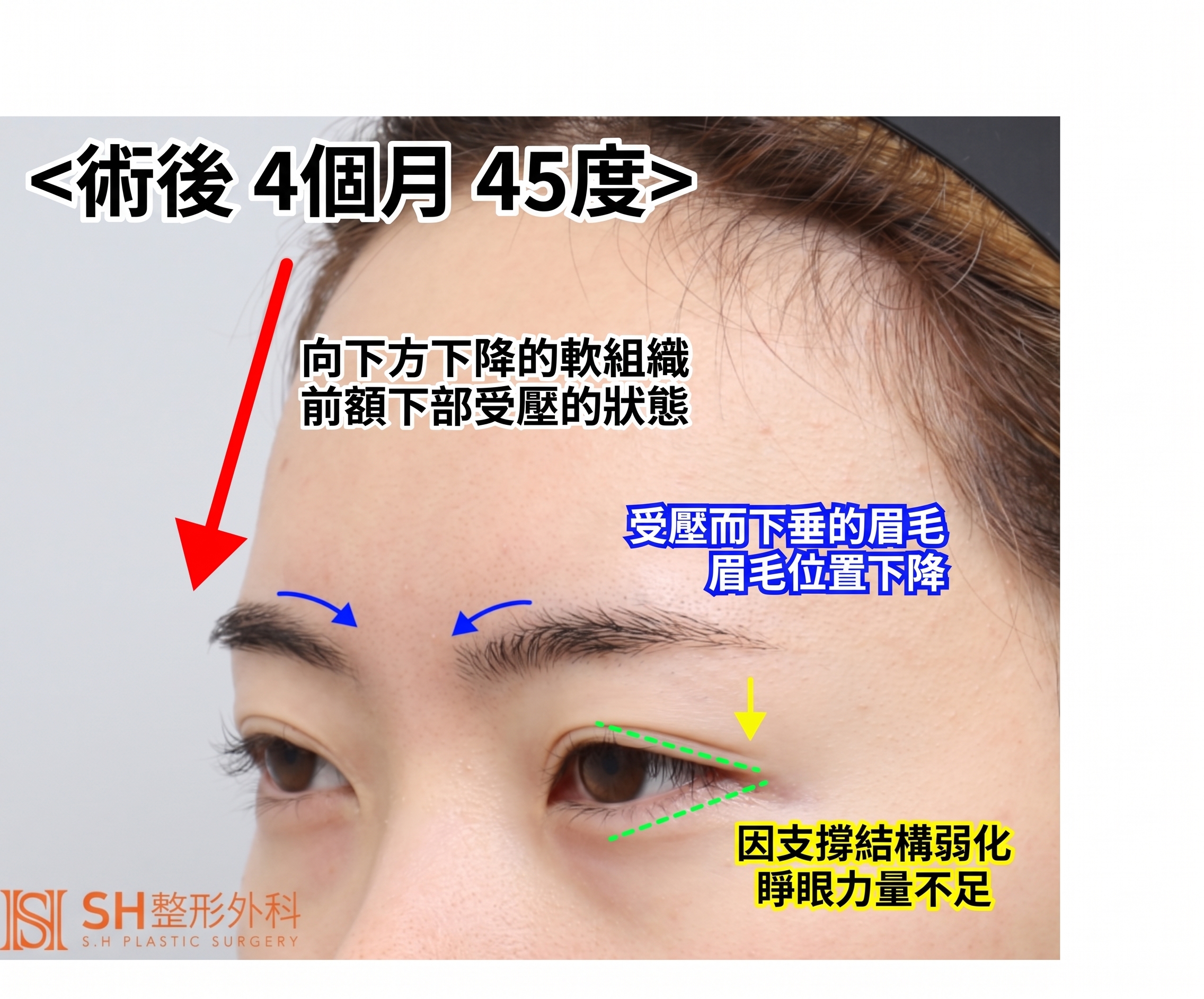 內視鏡前額拉提術、縫線式雙眼皮重修術與眉下切開拉提術,恢復眼部結構 SH整形外科 사진 10