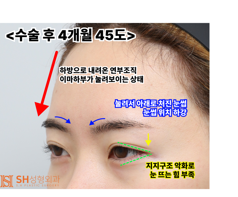 내시경 이마거상술과 매몰 쌍꺼풀 재수술, 눈썹하거상술로 회복된 눈매 구조 SH성형외과 에스에이치성형외과 사진 10