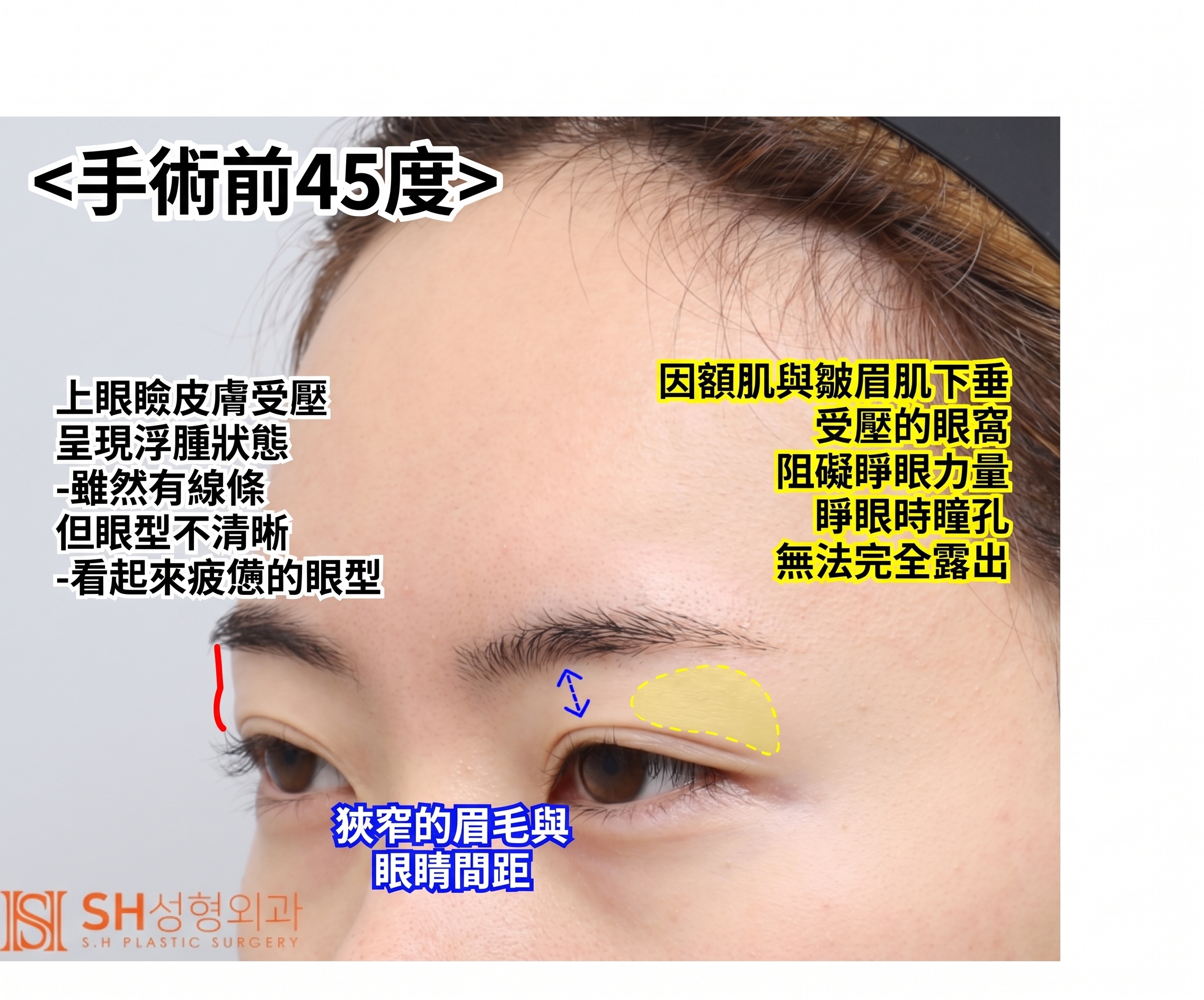 內視鏡前額拉提術、縫線式雙眼皮重修術與眉下切開拉提術,恢復眼部結構 SH整形外科 사진 11