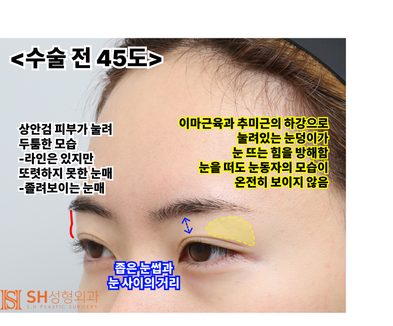 내시경 이마거상술과 매몰 쌍꺼풀 재수술, 눈썹하거상술로 회복된 눈매 구조 SH성형외과 에스에이치성형외과 사진 11