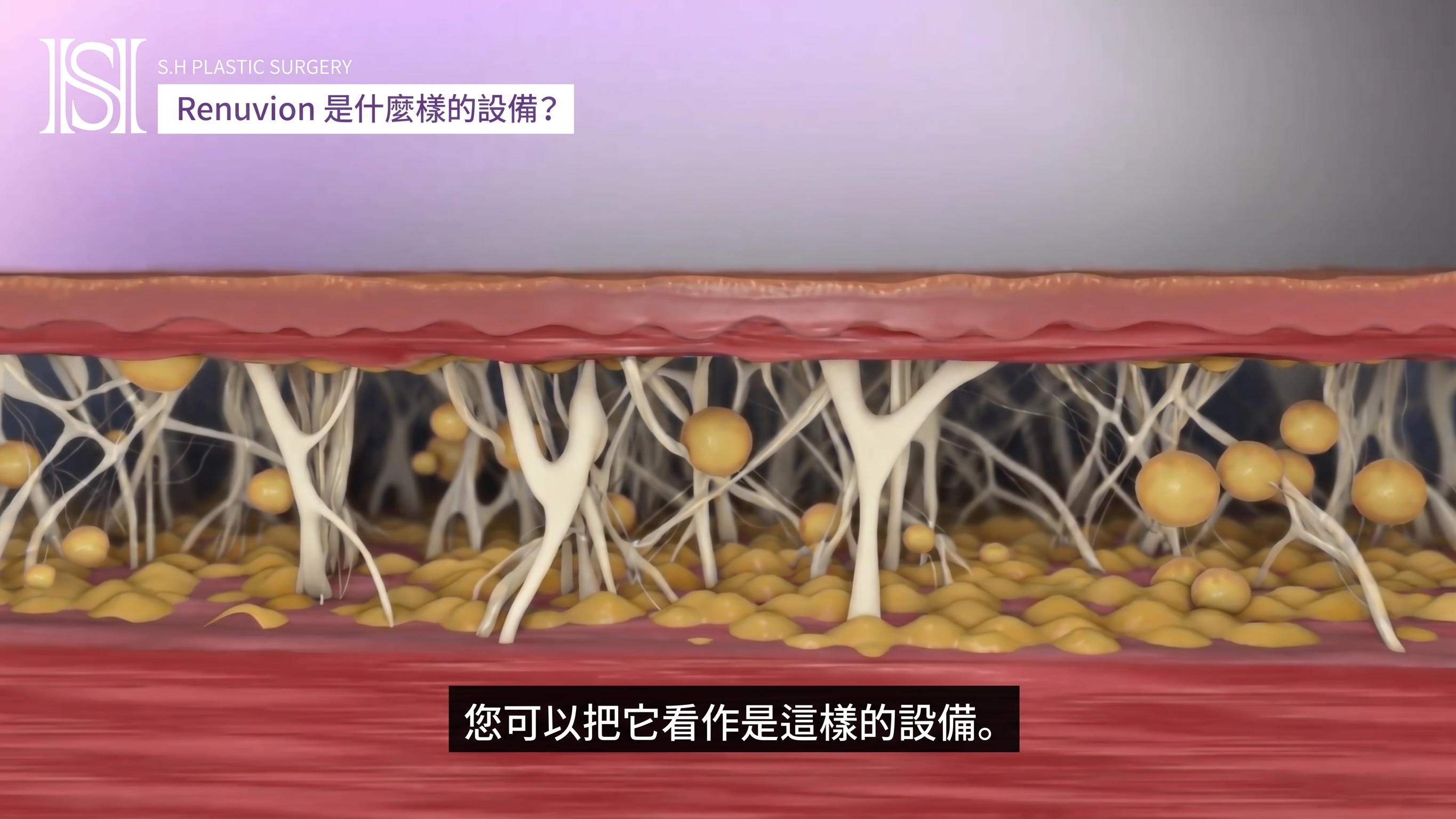 如果您擔心臉部輪廓手術後臉頰下垂,Renewbion 是您輪廓術後護理和下垂提拉的選擇! (附前後對比照片) 사진 21