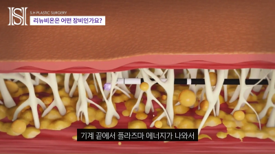 안면윤곽후볼처짐이 고민이라면 윤곽후관리와 처짐리프팅에 리뉴비온! (전후사진있음) 사진 19