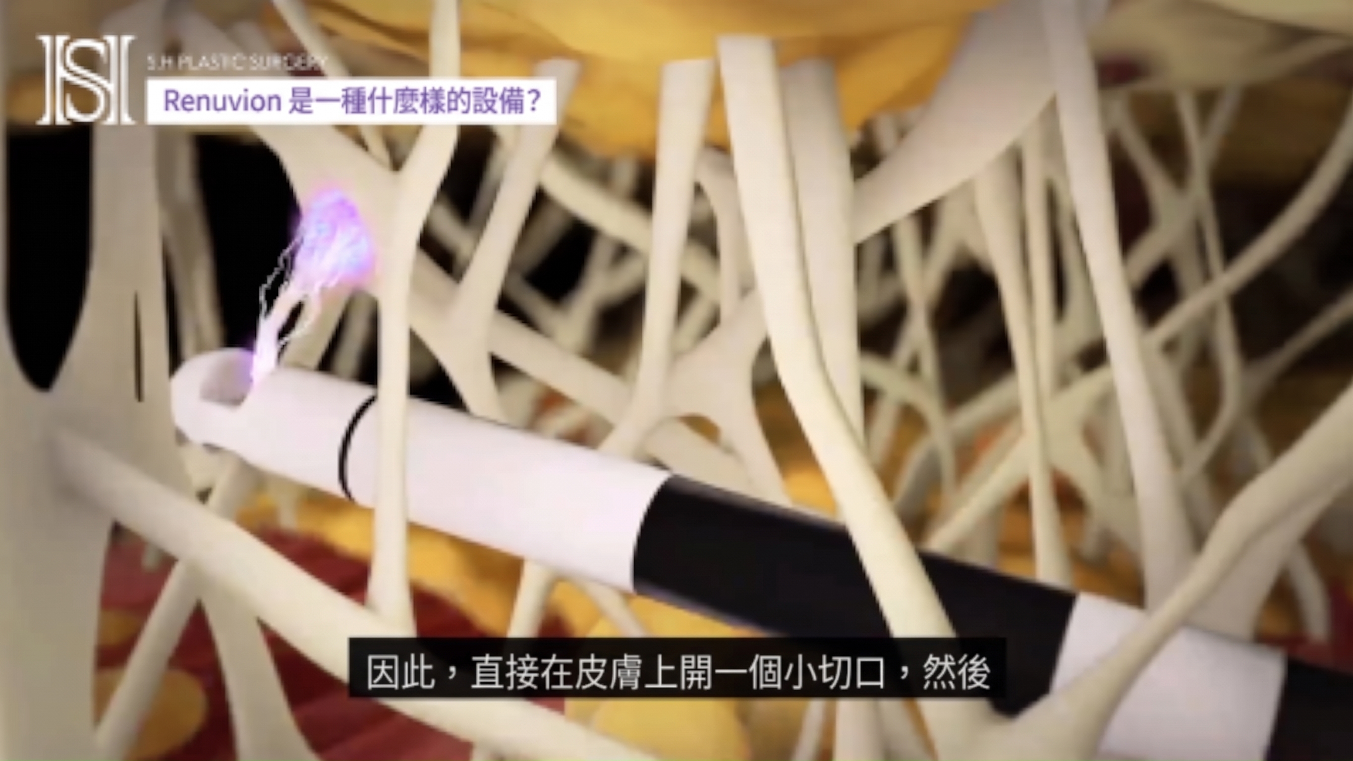 如果您擔心臉部輪廓手術後臉頰下垂,Renewbion 是您輪廓術後護理和下垂提拉的選擇! (附前後對比照片) 사진 18