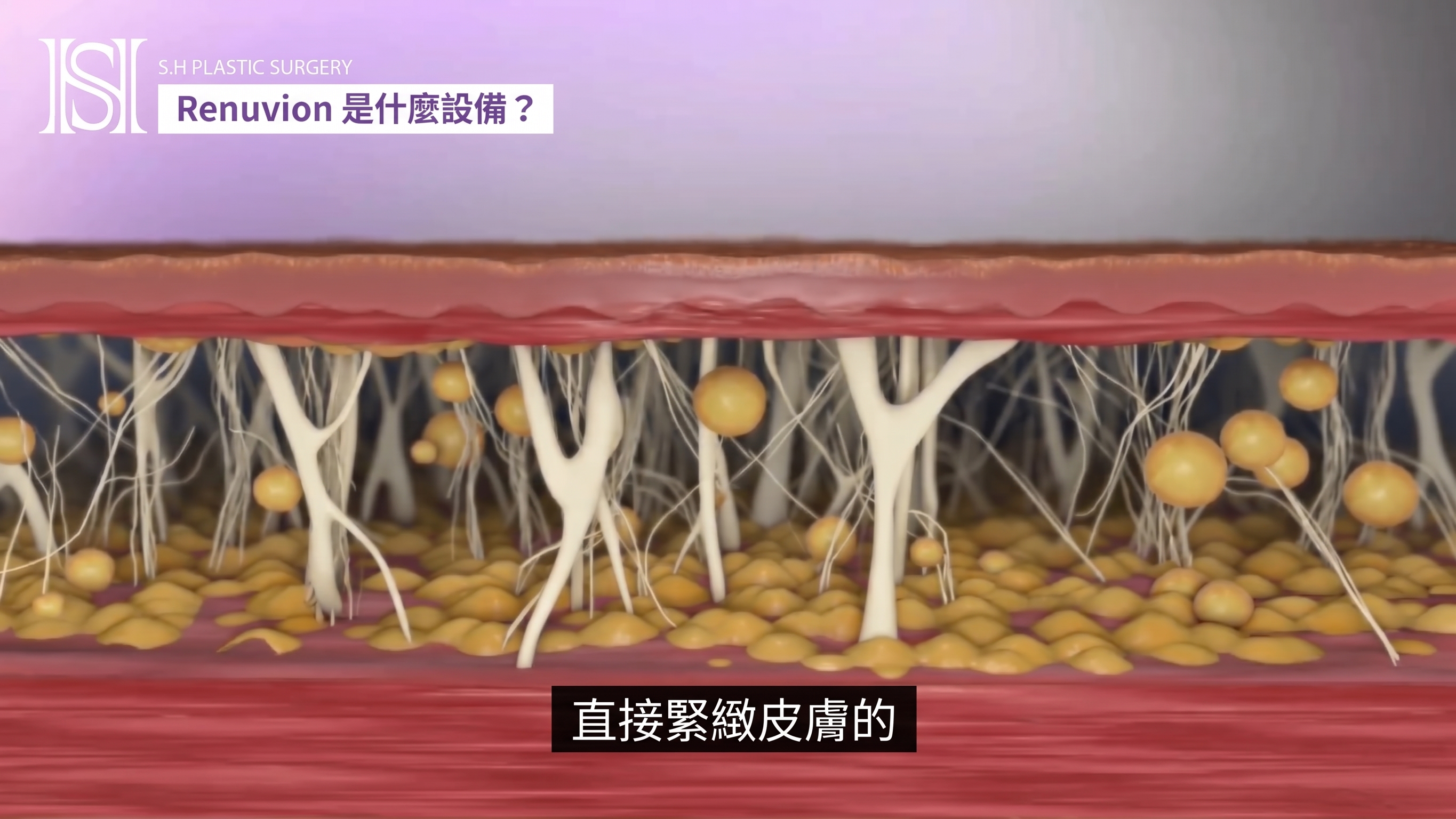 如果您擔心臉部輪廓手術後臉頰下垂,Renewbion 是您輪廓術後護理和下垂提拉的選擇! (附前後對比照片) 사진 20
