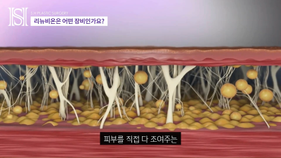 안면윤곽후볼처짐이 고민이라면 윤곽후관리와 처짐리프팅에 리뉴비온! (전후사진있음) 사진 20
