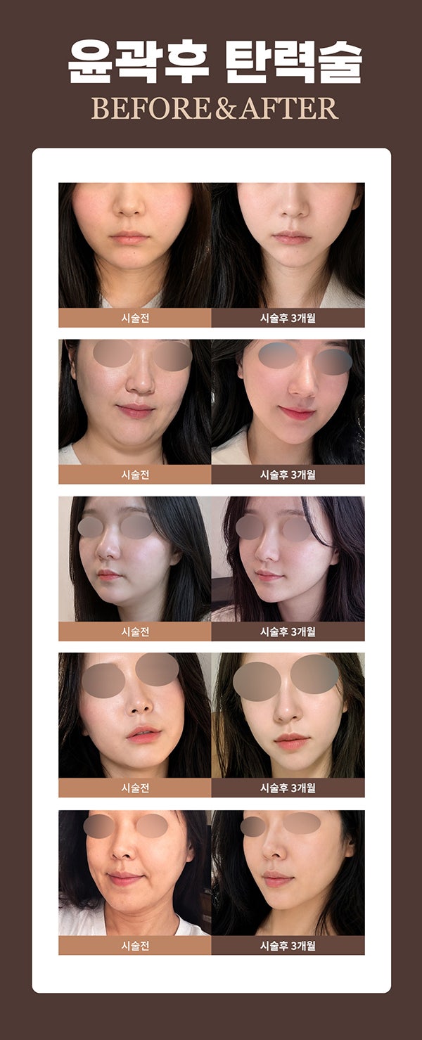 안면윤곽후볼처짐이 고민이라면 윤곽후관리와 처짐리프팅에 리뉴비온! (전후사진있음) 사진 12