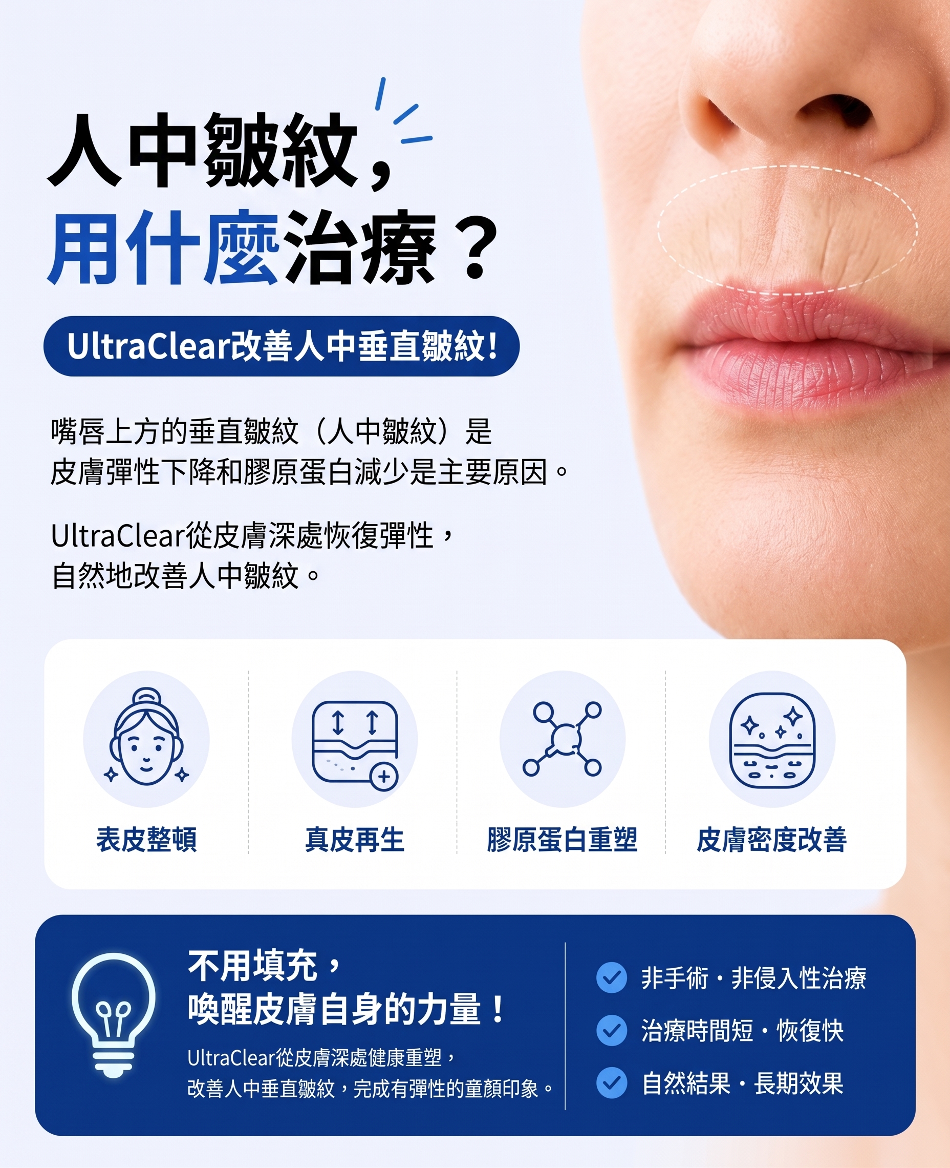 消除人中垂直貓咪紋的方法!SH整形外科招募整形模特兒~有人中困擾的請點擊!! 사진 9