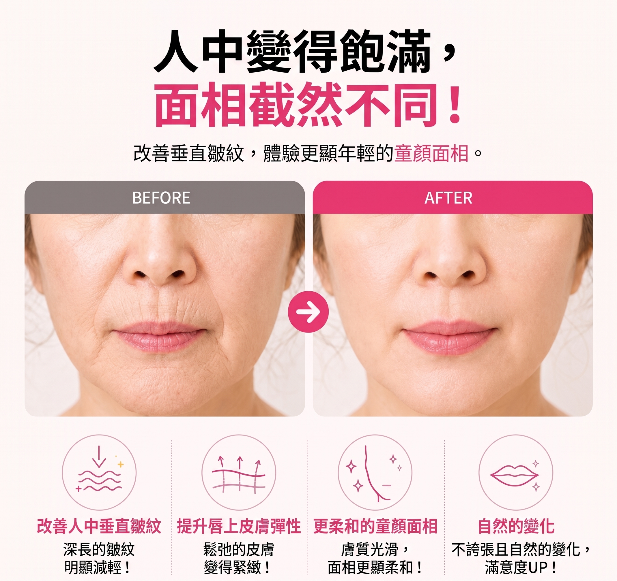 消除人中垂直貓咪紋的方法!SH整形外科招募整形模特兒~有人中困擾的請點擊!! 사진 5