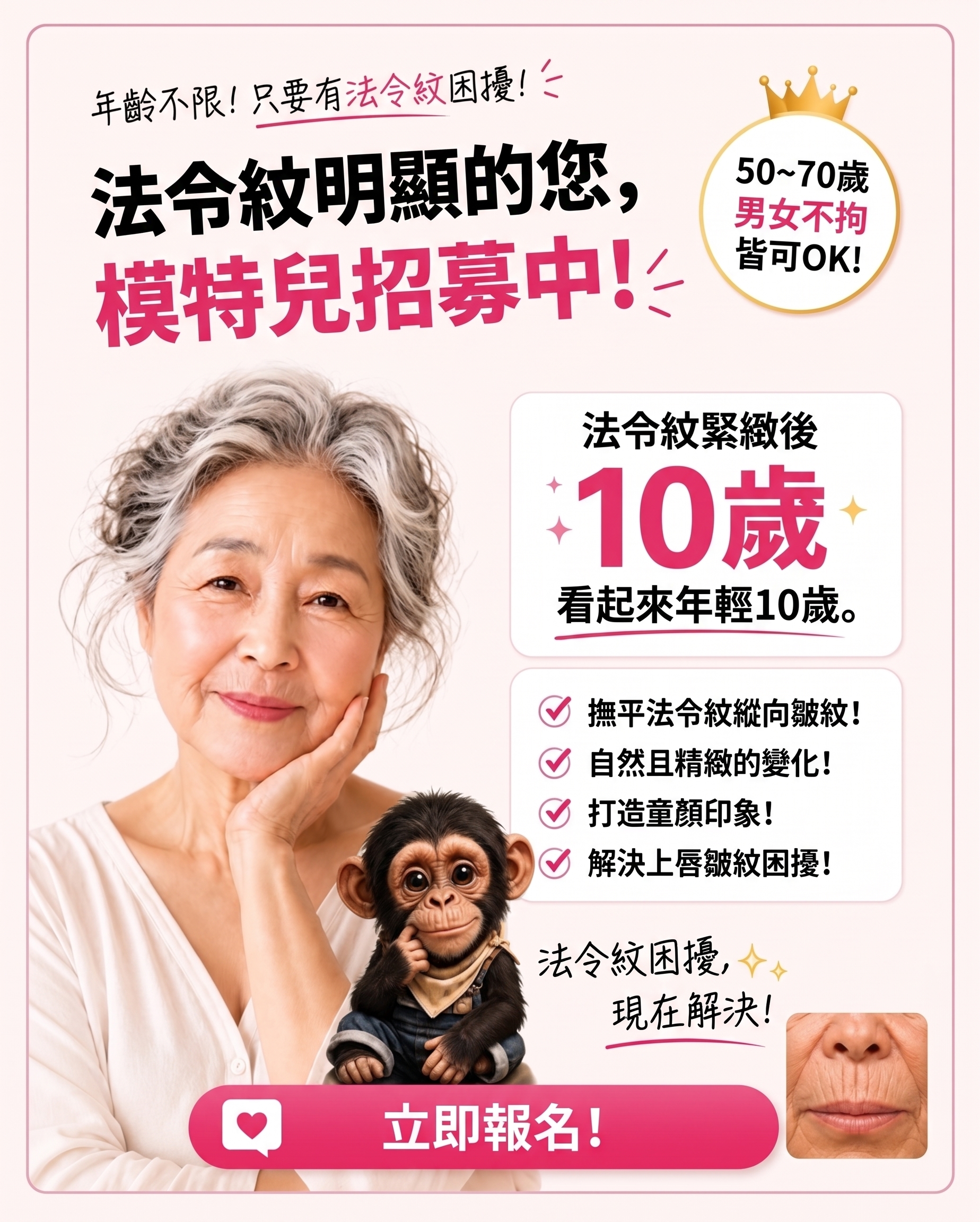消除人中垂直貓咪紋的方法!SH整形外科招募整形模特兒~有人中困擾的請點擊!!