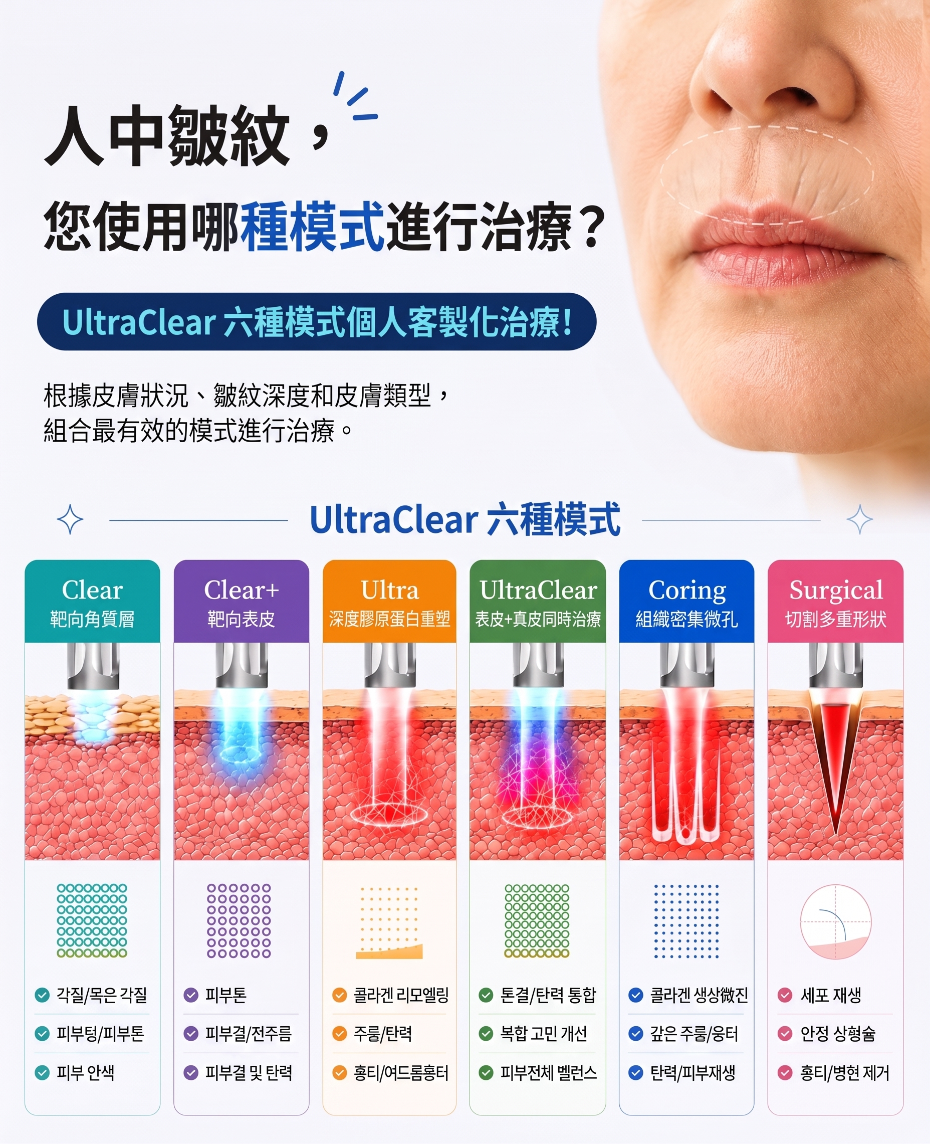 消除人中垂直貓咪紋的方法!SH整形外科招募整形模特兒~有人中困擾的請點擊!! 사진 11