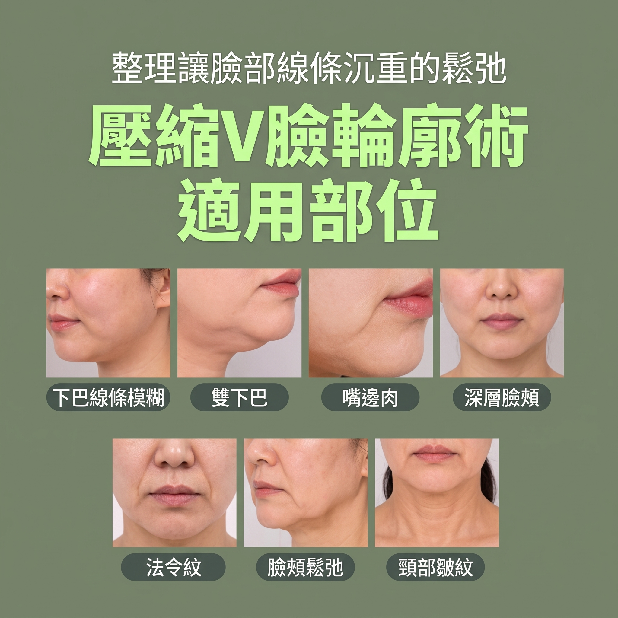 Renuvion臉部拉提 (sh)SH整形外科為您介紹非侵入式臉部拉提術~ 사진 12