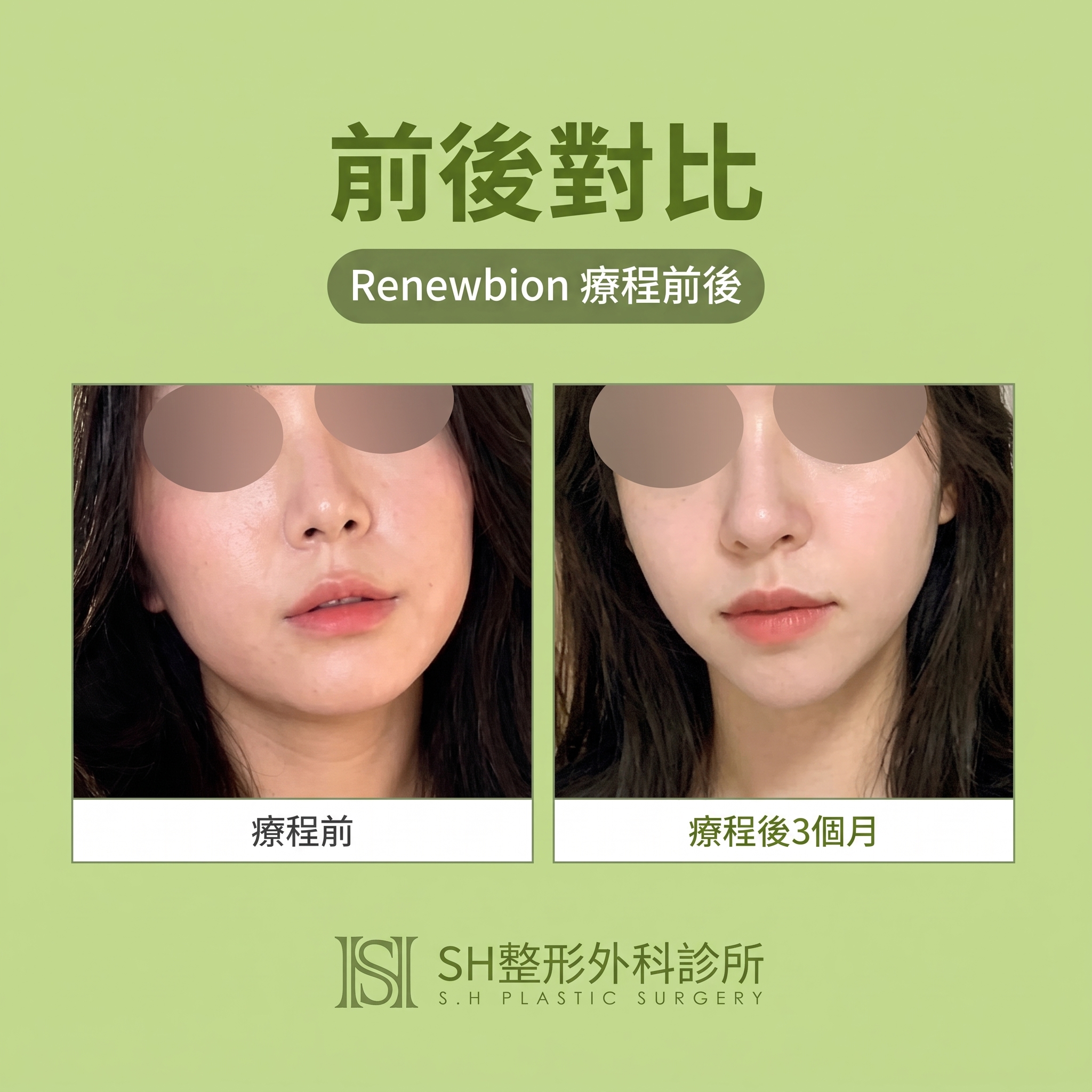 Renuvion臉部拉提 (sh)SH整形外科為您介紹非侵入式臉部拉提術~ 사진 3