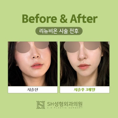 리뉴비온얼굴리프팅 (sh)에스에이치성형외과에서 비절개안면거상 알려드립니다~ 사진 3