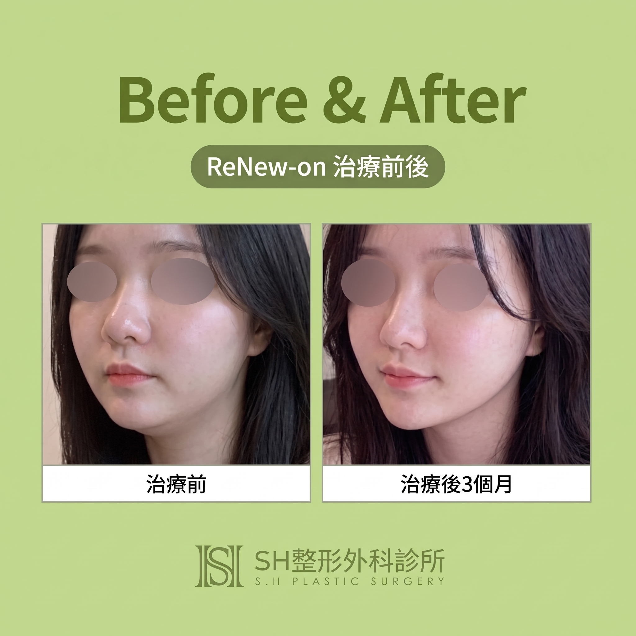 Renuvion臉部拉提 (sh)SH整形外科為您介紹非侵入式臉部拉提術~ 사진 4