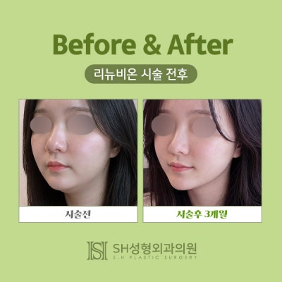 리뉴비온얼굴리프팅 (sh)에스에이치성형외과에서 비절개안면거상 알려드립니다~ 사진 4