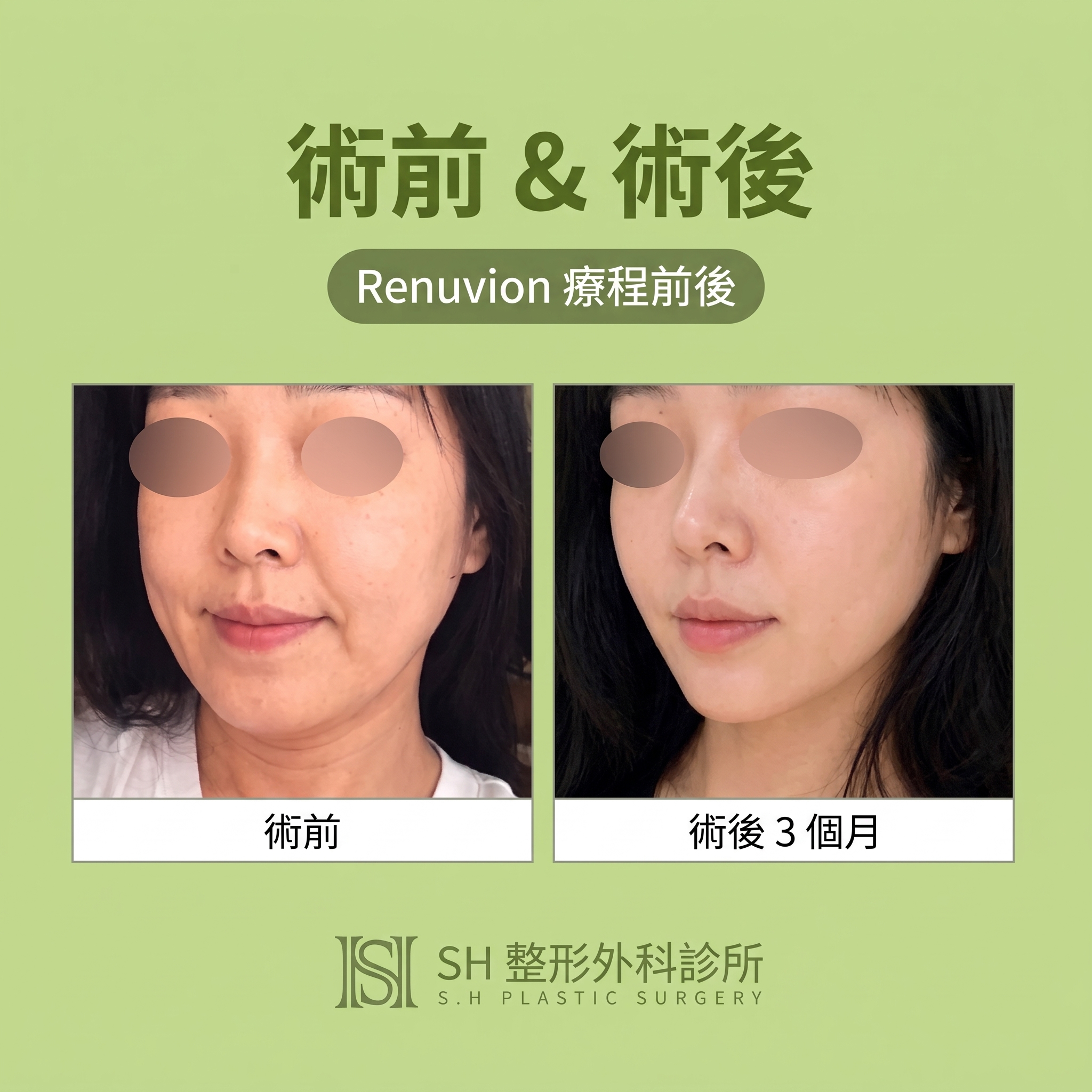 Renuvion臉部拉提 (sh)SH整形外科為您介紹非侵入式臉部拉提術~