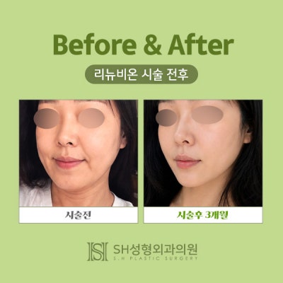 리뉴비온얼굴리프팅 (sh)에스에이치성형외과에서 비절개안면거상 알려드립니다~
