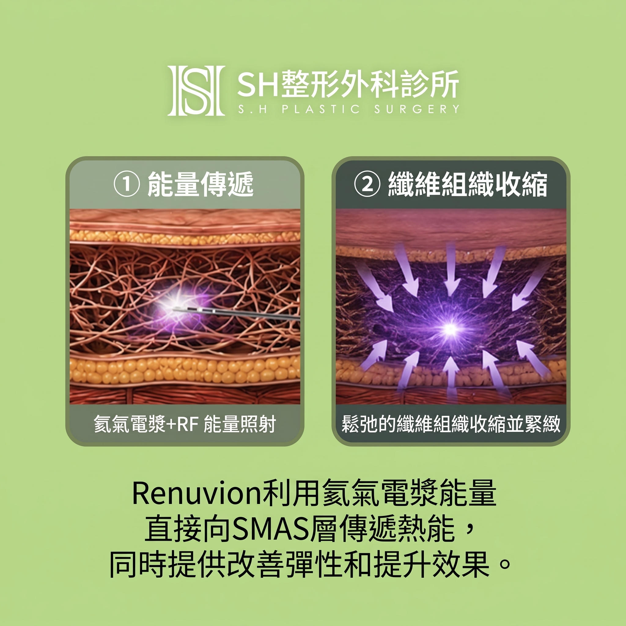 Renuvion臉部拉提 (sh)SH整形外科為您介紹非侵入式臉部拉提術~ 사진 10