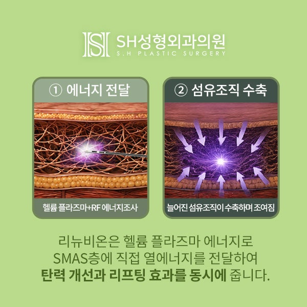 리뉴비온얼굴리프팅 (sh)에스에이치성형외과에서 비절개안면거상 알려드립니다~ 사진 10